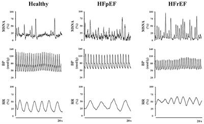 Contribution of Autonomic Reflexes to the Hyperadrenergic State in Heart Failure